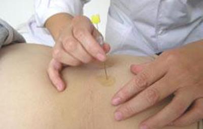 埋线减肥法的两大禁忌,谨记禁忌方能安全甩肉 减肥方法 第5张-瘦瘦减肥网 埋线减肥法的两大禁忌,谨记禁忌方能安全甩肉 减肥方法 第5张