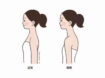 圆肩驼背怎么矫正 减肥 第4张-瘦瘦减肥网 圆肩驼背怎么矫正 减肥 第4张
