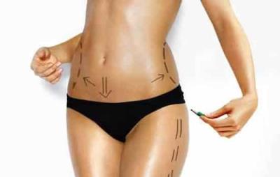 抽脂后注意事项，抽脂后谨记八大注意事项 抽脂减肥 第3张