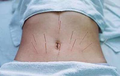 针灸减肥和拔罐减肥哪个好,关键看自身适合哪种减肥方式 针灸减肥 第4张-瘦瘦减肥网 针灸减肥和拔罐减肥哪个好,关键看自身适合哪种减肥方式 针灸减肥 第4张