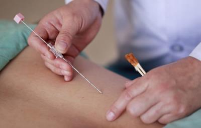 针灸减肥和拔罐减肥哪个好,关键看自身适合哪种减肥方式 针灸减肥 第2张-瘦瘦减肥网 针灸减肥和拔罐减肥哪个好,关键看自身适合哪种减肥方式 针灸减肥 第2张