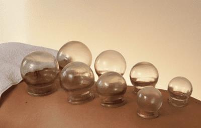 针灸减肥和拔罐减肥哪个好,关键看自身适合哪种减肥方式 针灸减肥 第6张-瘦瘦减肥网 针灸减肥和拔罐减肥哪个好,关键看自身适合哪种减肥方式 针灸减肥 第6张