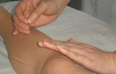 针灸埋线的原理,减肥成功的四大优势 针灸减肥 第2张-瘦瘦减肥网 针灸埋线的原理,减肥成功的四大优势 针灸减肥 第2张