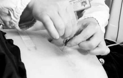 针灸埋线的原理,减肥成功的四大优势 针灸减肥 第3张-瘦瘦减肥网 针灸埋线的原理,减肥成功的四大优势 针灸减肥 第3张