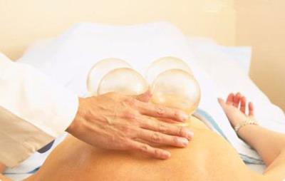 拔罐减肥有效吗,期间吃什么最佳 拔罐减肥 第2张-瘦瘦减肥网 拔罐减肥有效吗,期间吃什么最佳 拔罐减肥 第2张