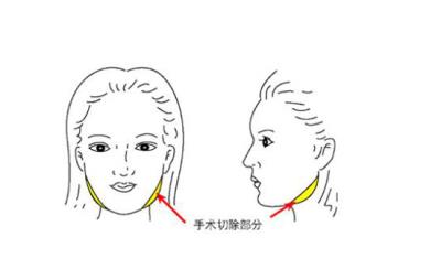 脸宽骨骼大怎么办,瘦脸前先辨清脸型 瘦脸 第1张-瘦瘦减肥网 脸宽骨骼大怎么办,瘦脸前先辨清脸型 瘦脸 第1张