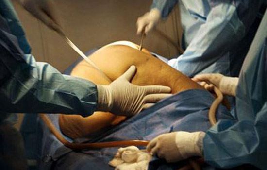 抽脂肪对身体有害吗(手臂抽脂肪对身体有害吗) 瘦手臂 第1张-瘦瘦减肥网 抽脂肪对身体有害吗(手臂抽脂肪对身体有害吗) 瘦手臂 第1张