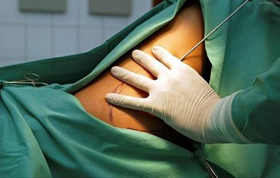 抽脂肪对身体有害吗(手臂抽脂肪对身体有害吗) 瘦手臂 第2张-瘦瘦减肥网 抽脂肪对身体有害吗(手臂抽脂肪对身体有害吗) 瘦手臂 第2张