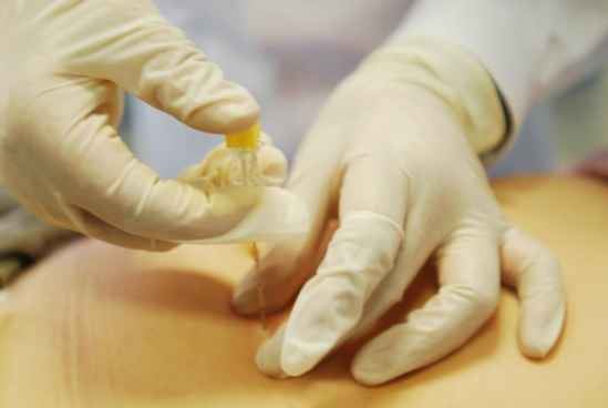 埋线减肥法的副作用(埋线减肥法的两大禁忌) 减肥方法 第1张