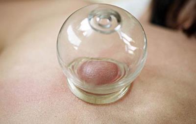 拔罐减肥有副作用吗,操作不当后果糟糕 拔罐减肥 第1张-瘦瘦减肥网 拔罐减肥有副作用吗,操作不当后果糟糕 拔罐减肥 第1张