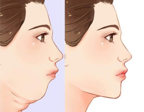 如何减掉双下巴上的肉(怎么减掉脖子和下巴上的肉) 瘦脸 第1张-瘦瘦减肥网 如何减掉双下巴上的肉(怎么减掉脖子和下巴上的肉) 瘦脸 第1张