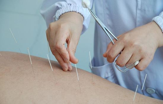 针灸减肥效果(全身针灸减肥有用吗) 针灸减肥 第2张-瘦瘦减肥网 针灸减肥效果(全身针灸减肥有用吗) 针灸减肥 第2张
