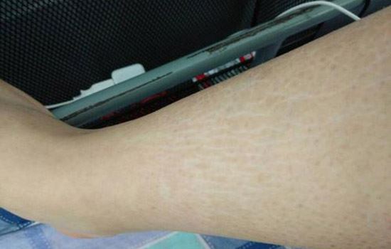 肥胖纹怎么淡化(肥胖纹怎么去) 关于肥胖 第1张-瘦瘦减肥网 肥胖纹怎么淡化(肥胖纹怎么去) 关于肥胖 第1张