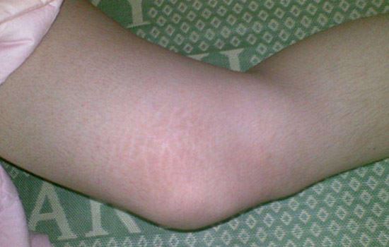 肥胖纹怎么淡化(肥胖纹怎么去) 关于肥胖 第2张-瘦瘦减肥网 肥胖纹怎么淡化(肥胖纹怎么去) 关于肥胖 第2张