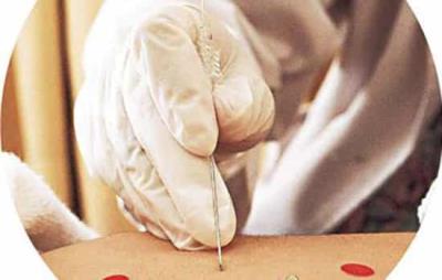 针灸埋线减肥的注意事项有哪些 针灸减肥 第1张-瘦瘦减肥网 针灸埋线减肥的注意事项有哪些 针灸减肥 第1张