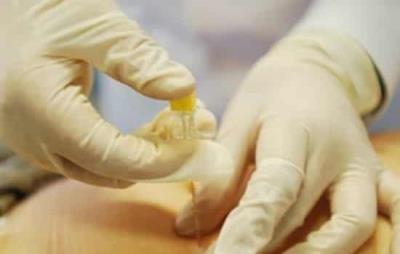 针灸埋线减肥的注意事项有哪些 针灸减肥 第2张-瘦瘦减肥网 针灸埋线减肥的注意事项有哪些 针灸减肥 第2张