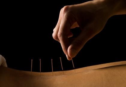 针灸减肥的原理及危害(针灸减肥多少钱一个疗程) 针灸减肥 第1张