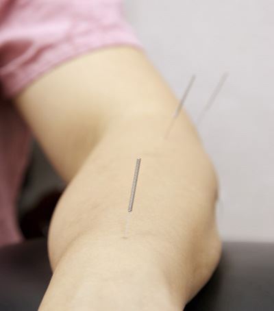 针灸减肥瘦身的原理与副作用 针灸减肥 第1张