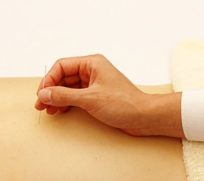 针灸减肥瘦身的原理与副作用 针灸减肥 第4张