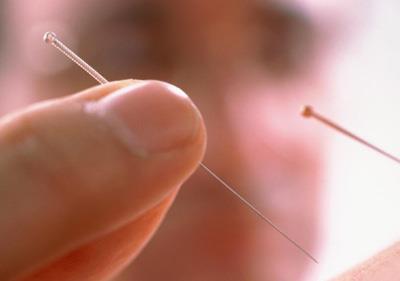 针灸减肥的原理与副作用 针灸减肥 第2张