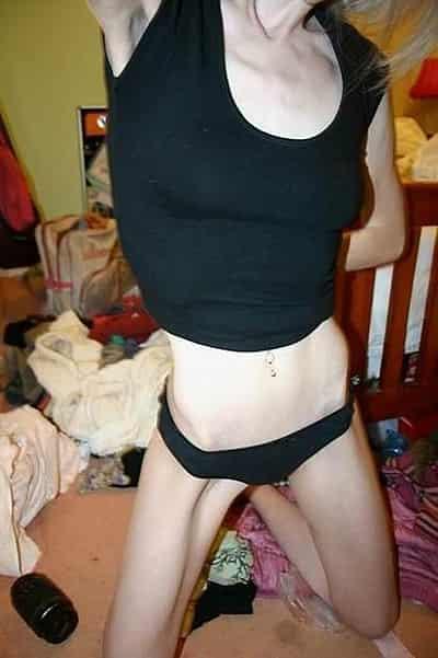 神经性厌食症的后果，疯狂减肥达人不堪入目 减肥 第2张