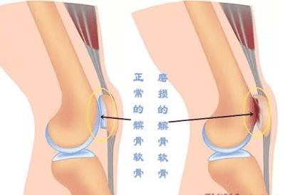 跑步后膝盖疼怎么恢复，跑步新手和老鸟必备技能 跑步减肥 第3张