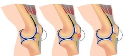 四个腰腹吸脂案例 瘦腰 第2张-瘦瘦减肥网 四个腰腹吸脂案例 瘦腰 第2张