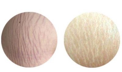 肥胖纹可以去掉吗 关于肥胖 第1张-瘦瘦减肥网 肥胖纹可以去掉吗 关于肥胖 第1张